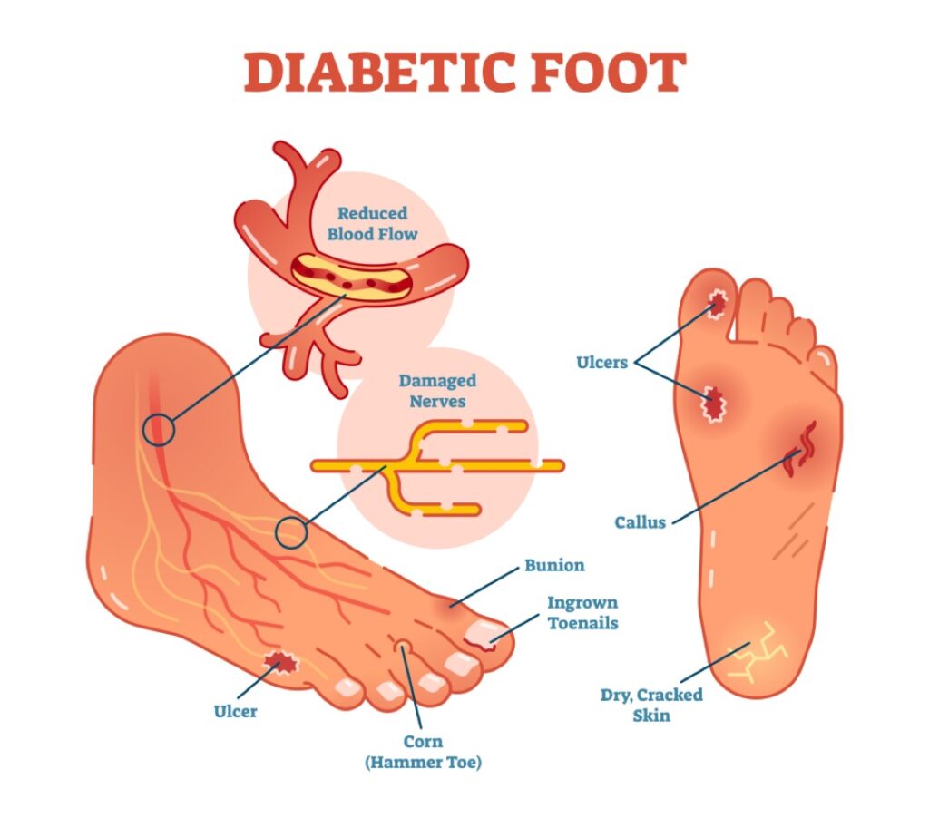Diabetic foot - how Orthotics help