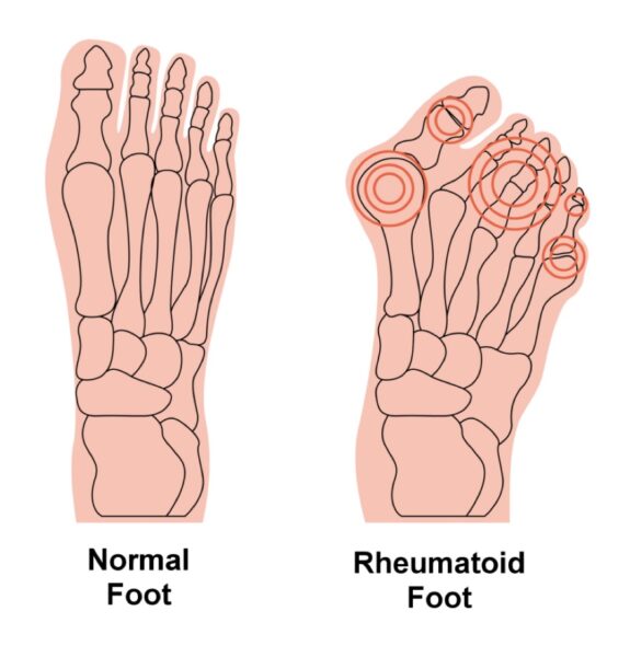 Rheumatoid Arthritis how Orthotics help? Ease The Feet